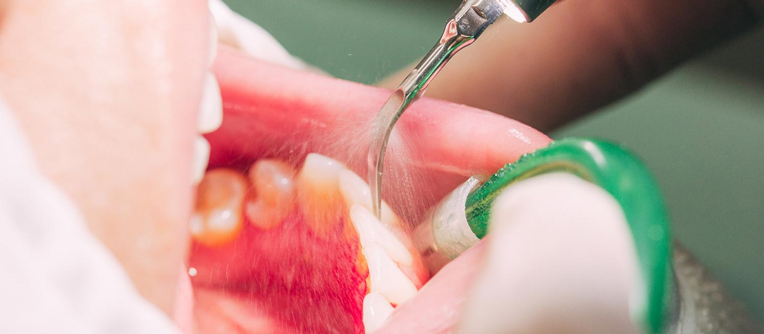 Prophylaxe in der Zahnarztpraxis Nagel in Themar
